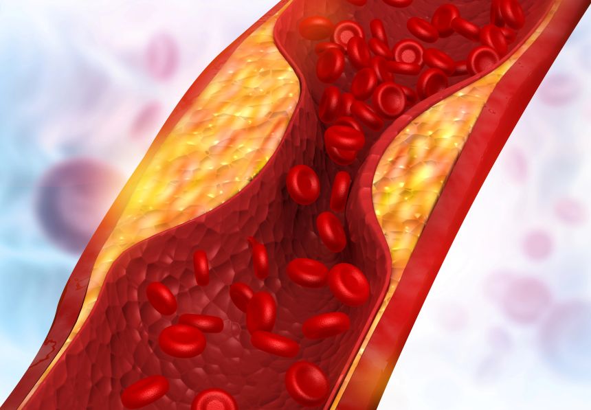 Ucpaná tepna, arterialní plak. Masticha Chios cholesterol a trávení Foto 1: Masticha z ostrova Chios a její pěstování. Masticha Chios cholesterol a trávení